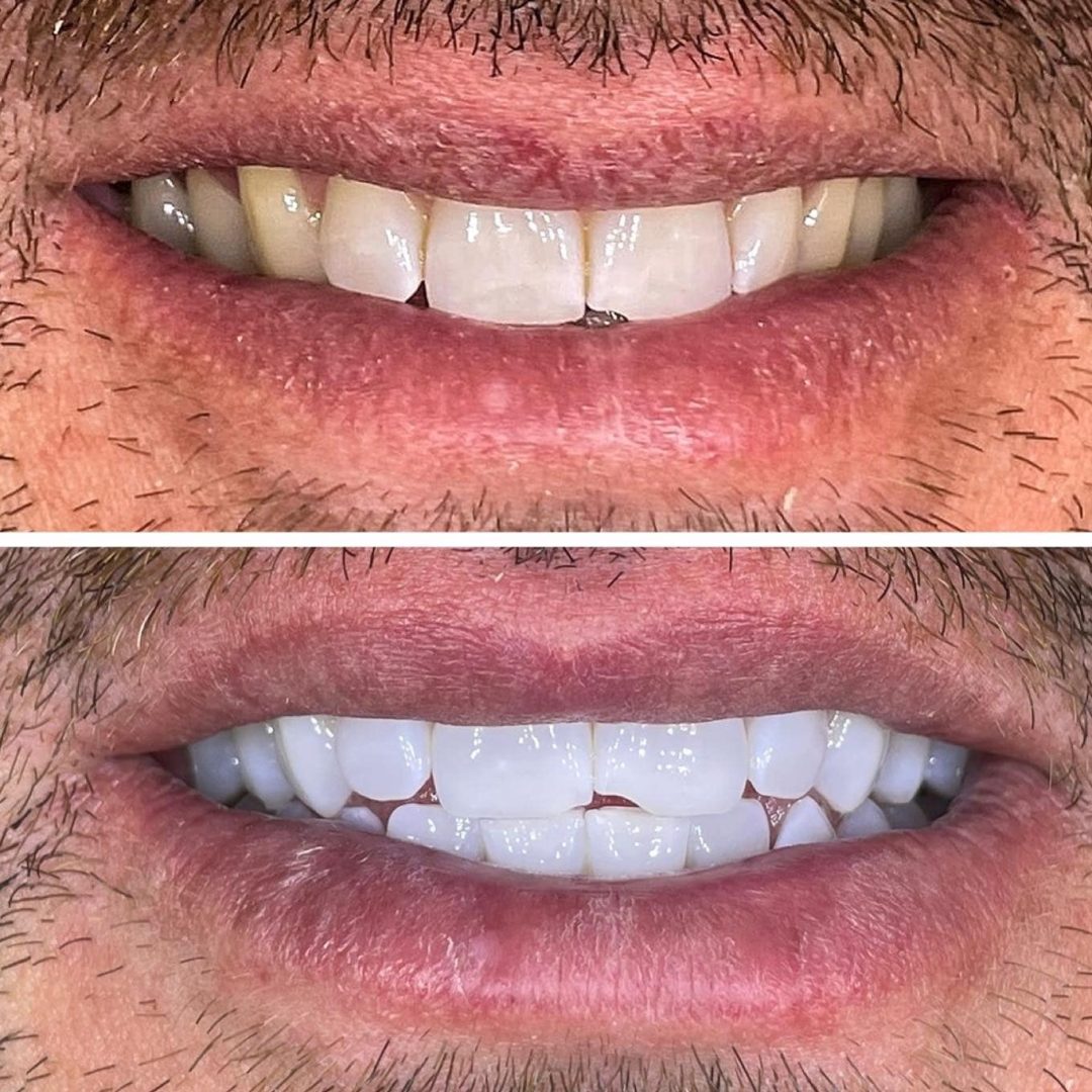 KIPA SMILE PRIMA E DOPO (1)