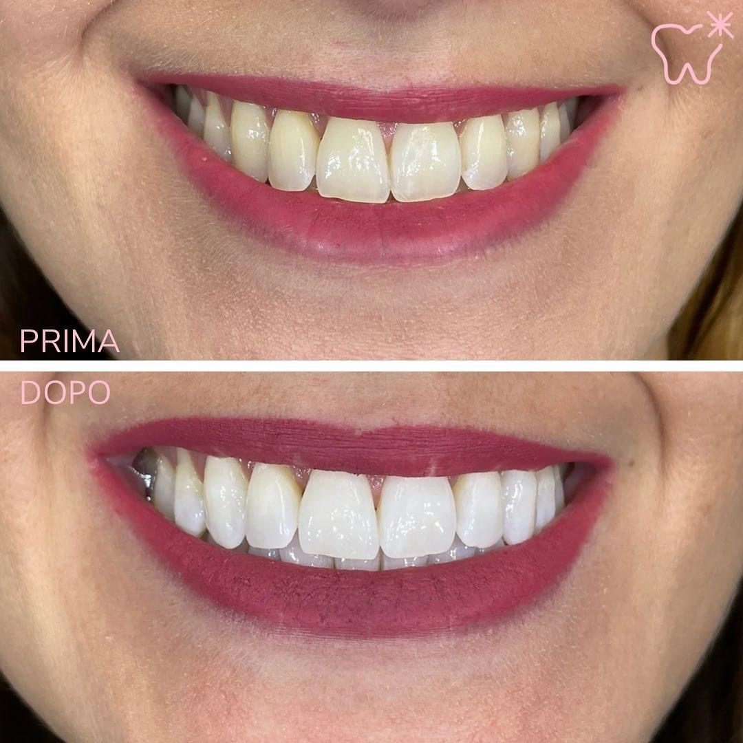 KIPA SMILE PRIMA E DOPO (10)