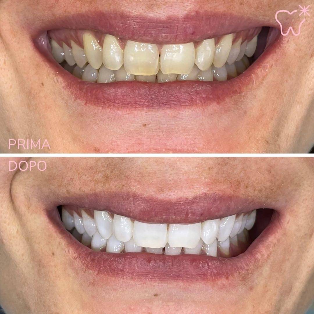 KIPA SMILE PRIMA E DOPO (11)