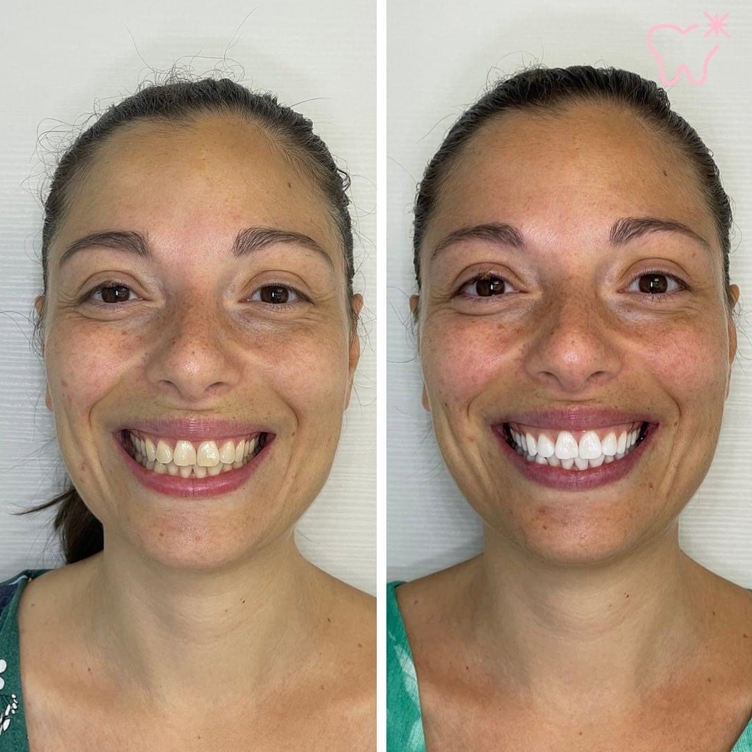 KIPA SMILE PRIMA E DOPO (12)