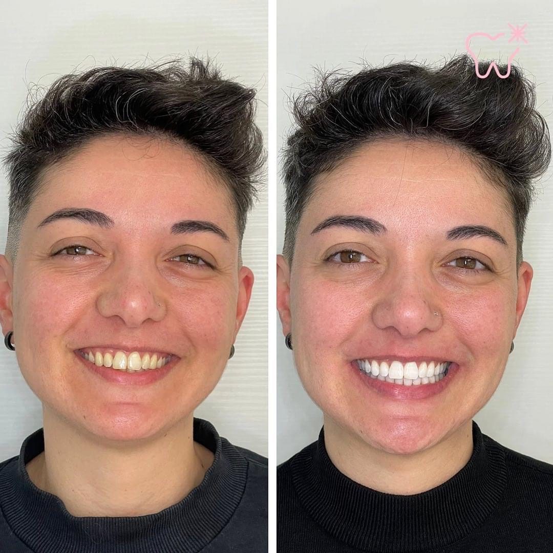 KIPA SMILE PRIMA E DOPO (13)