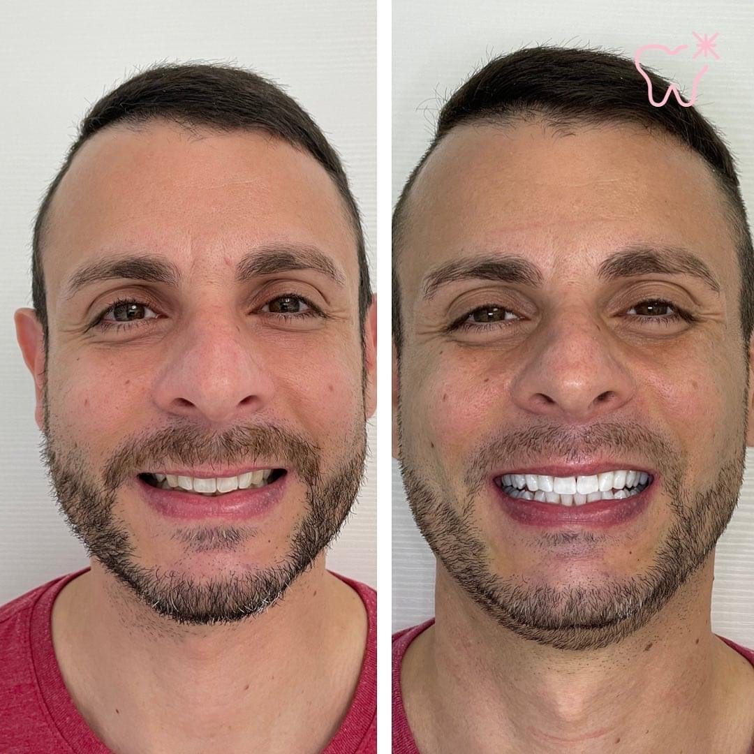 KIPA SMILE PRIMA E DOPO (14)