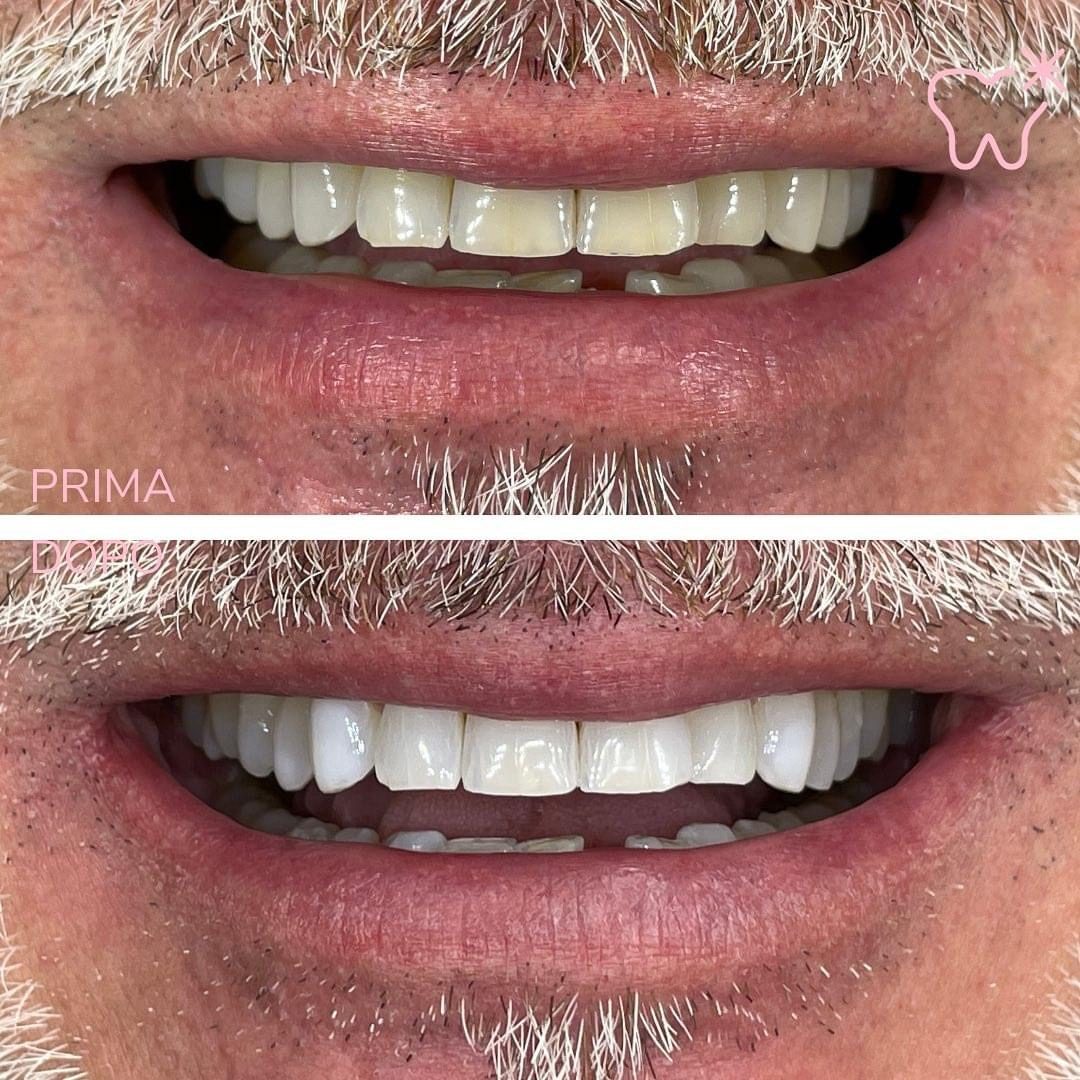 KIPA SMILE PRIMA E DOPO (15)