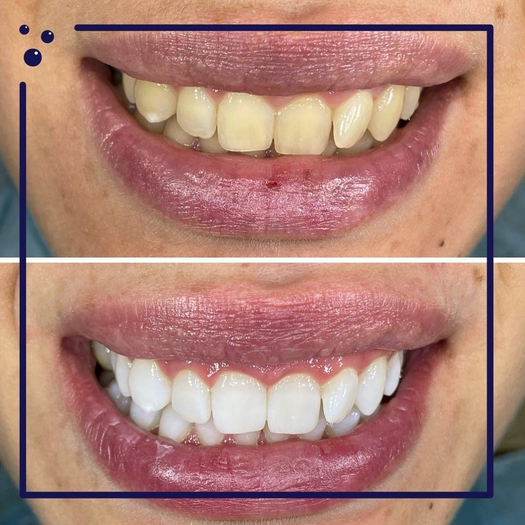 KIPA SMILE PRIMA E DOPO (16)