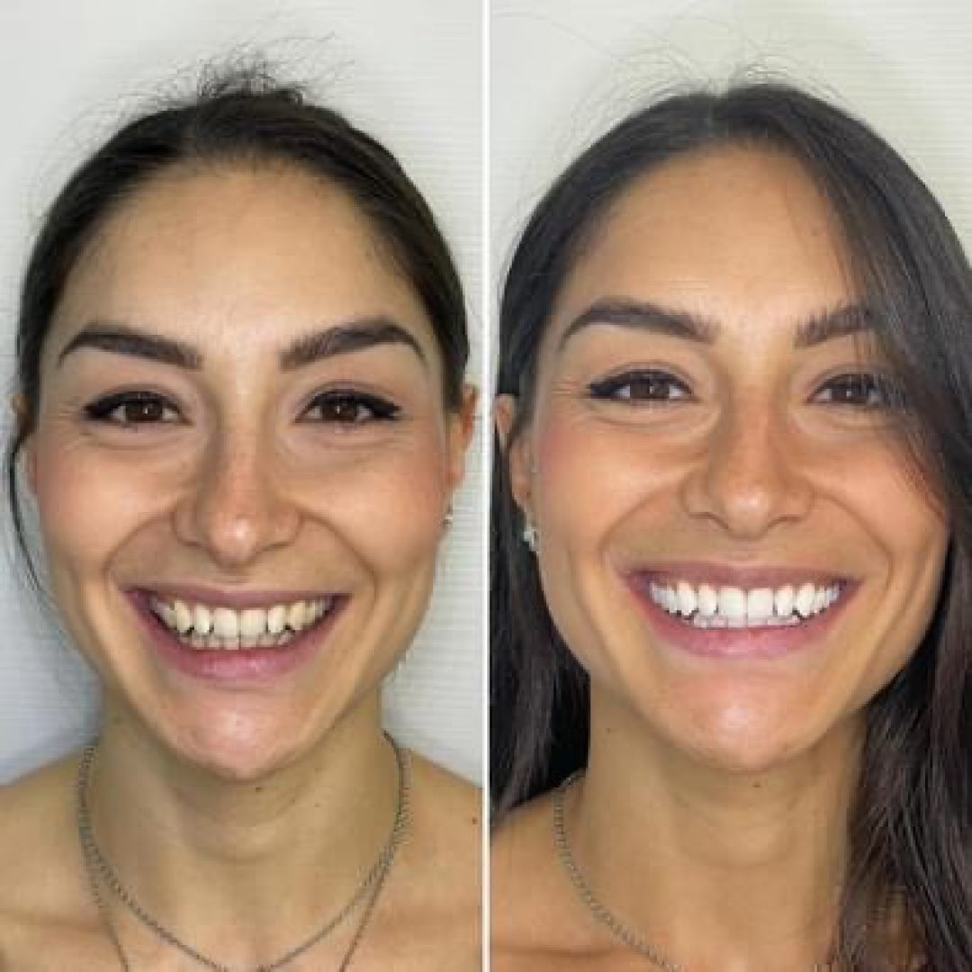 KIPA SMILE PRIMA E DOPO (17)