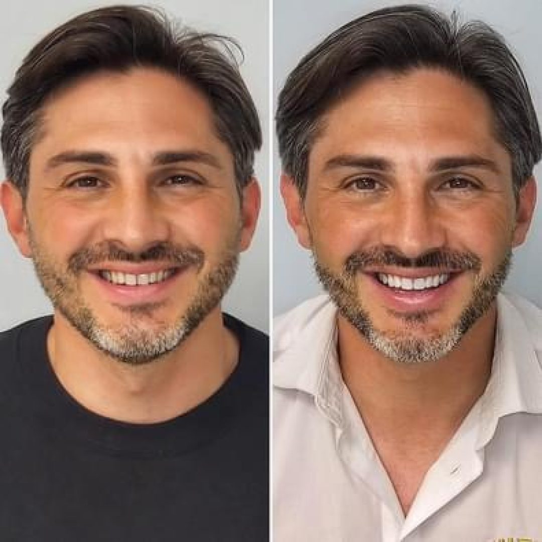 KIPA SMILE PRIMA E DOPO (18)