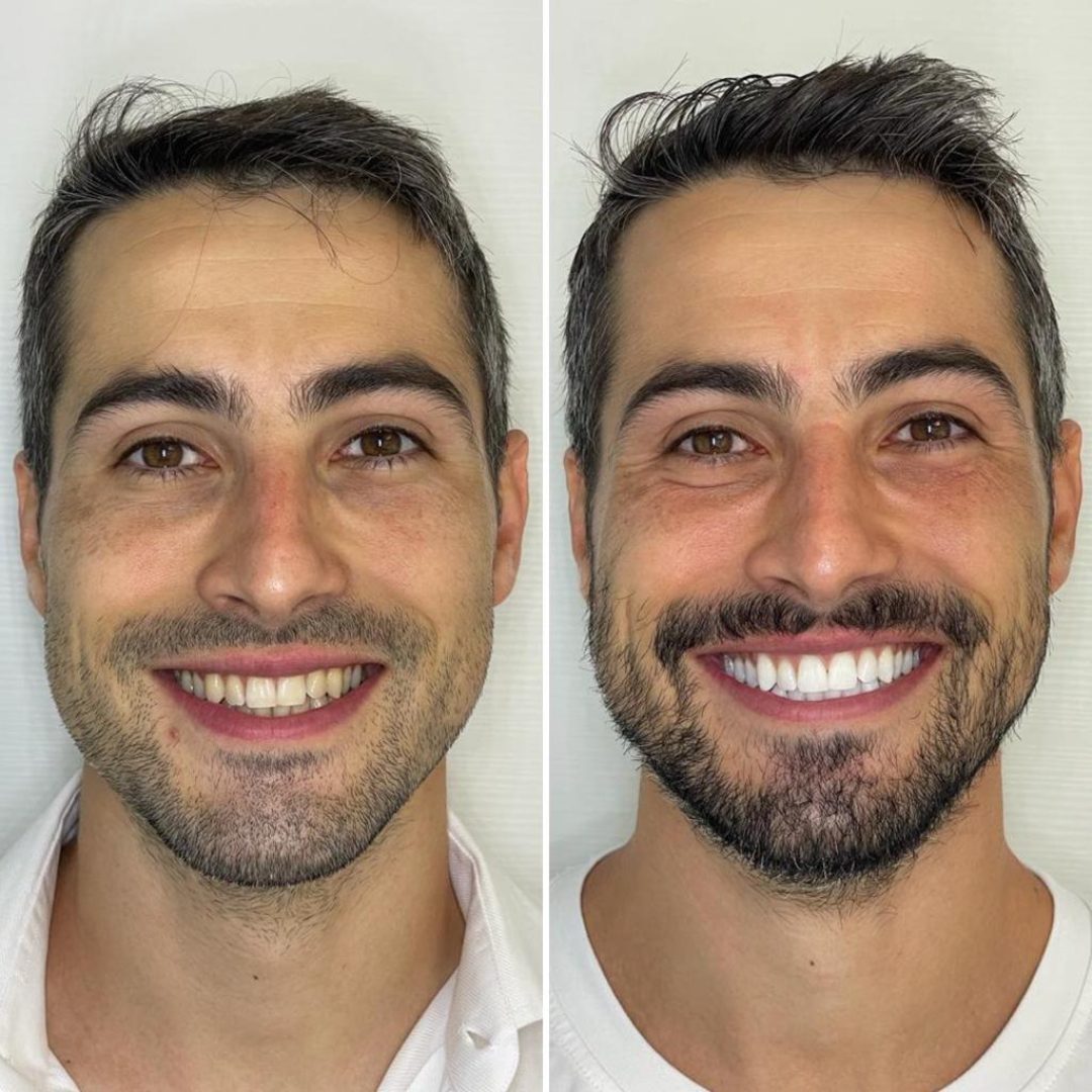 KIPA SMILE PRIMA E DOPO (19)