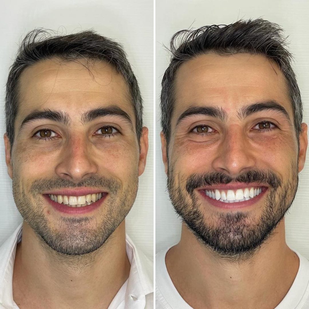 KIPA SMILE PRIMA E DOPO (2)