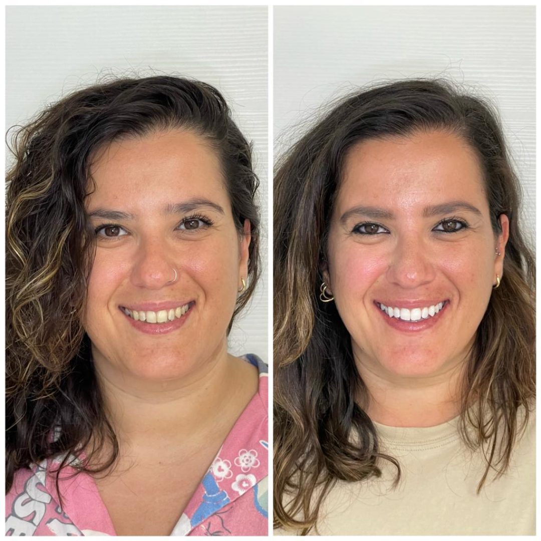 KIPA SMILE PRIMA E DOPO (20)