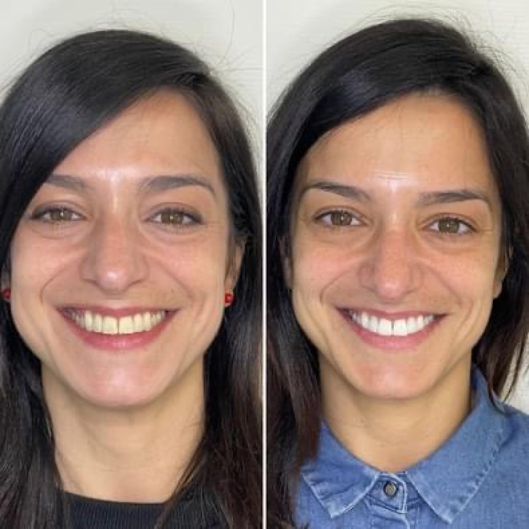 KIPA SMILE PRIMA E DOPO (21)