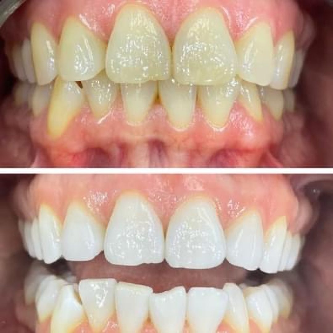 KIPA SMILE PRIMA E DOPO (22)