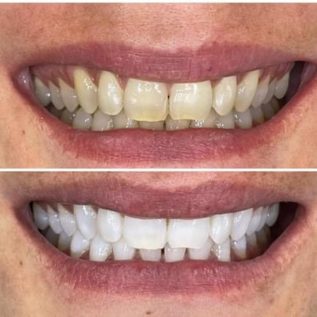 KIPA SMILE PRIMA E DOPO (23)