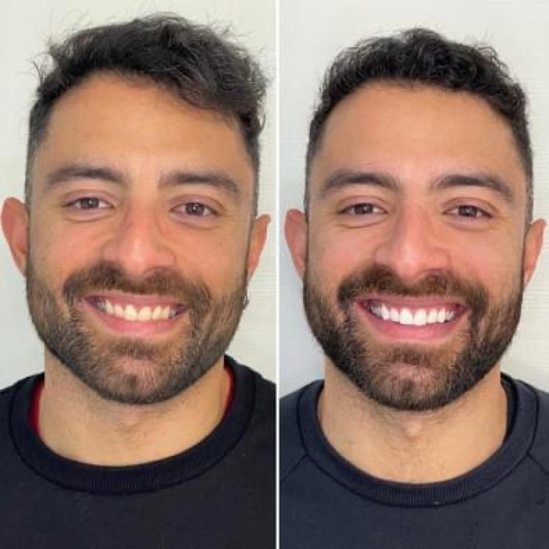 KIPA SMILE PRIMA E DOPO (24)