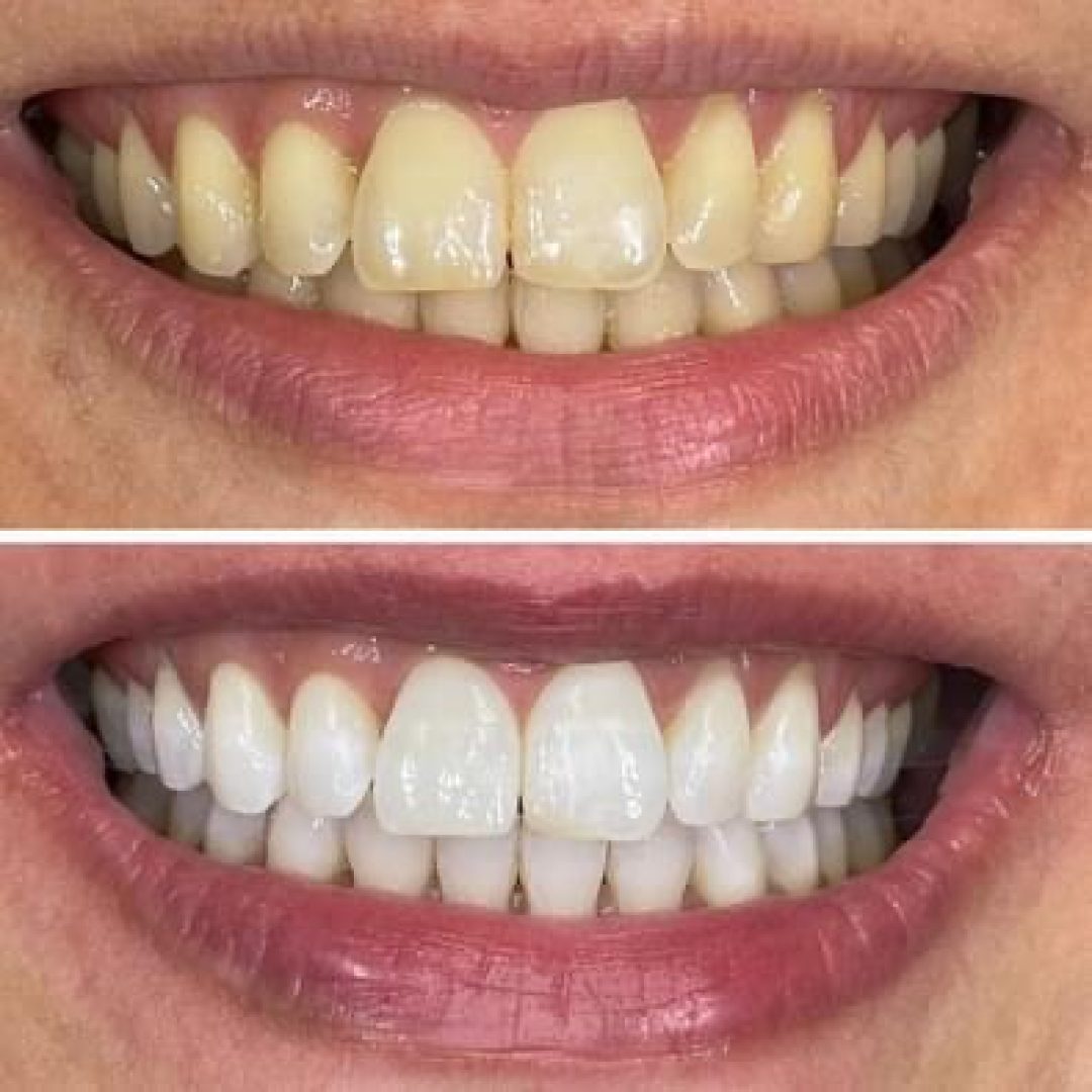 KIPA SMILE PRIMA E DOPO (25)