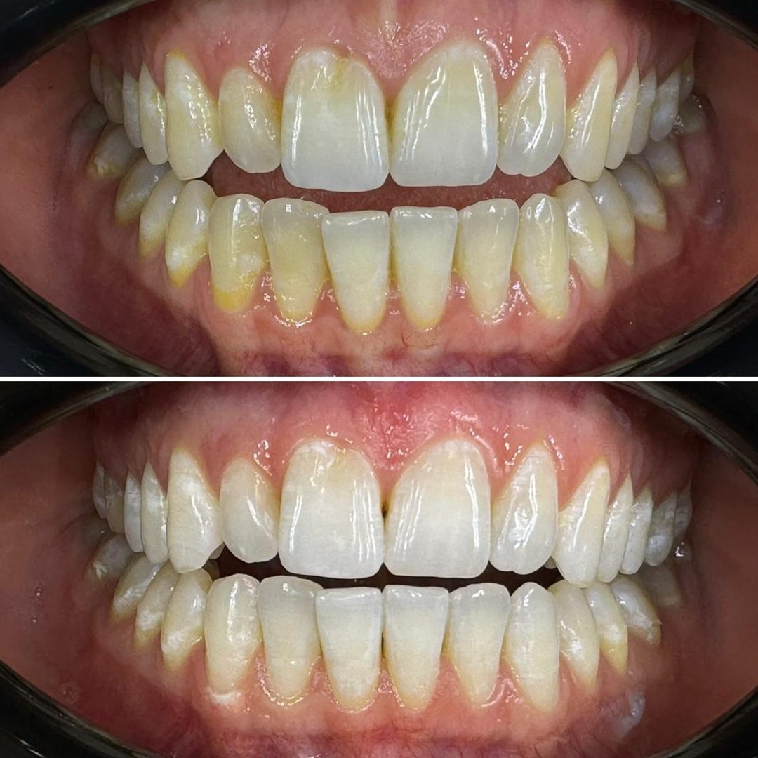 KIPA SMILE PRIMA E DOPO (26)