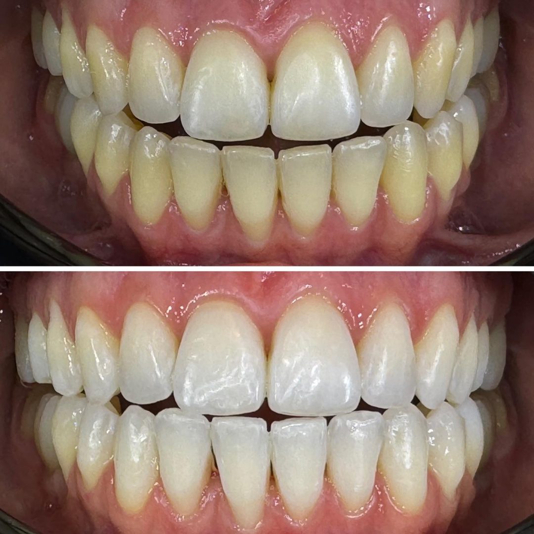 KIPA SMILE PRIMA E DOPO (27)