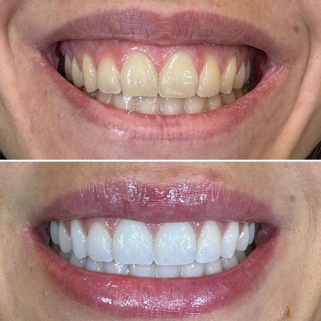 KIPA SMILE PRIMA E DOPO (28)