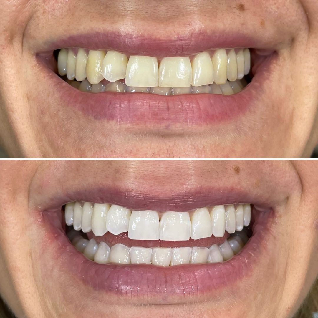 KIPA SMILE PRIMA E DOPO (29)