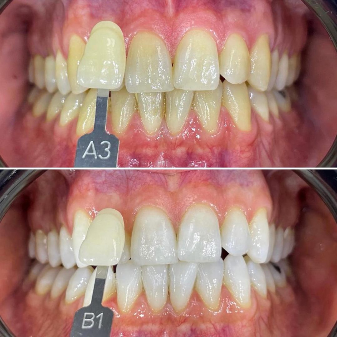 KIPA SMILE PRIMA E DOPO (3)