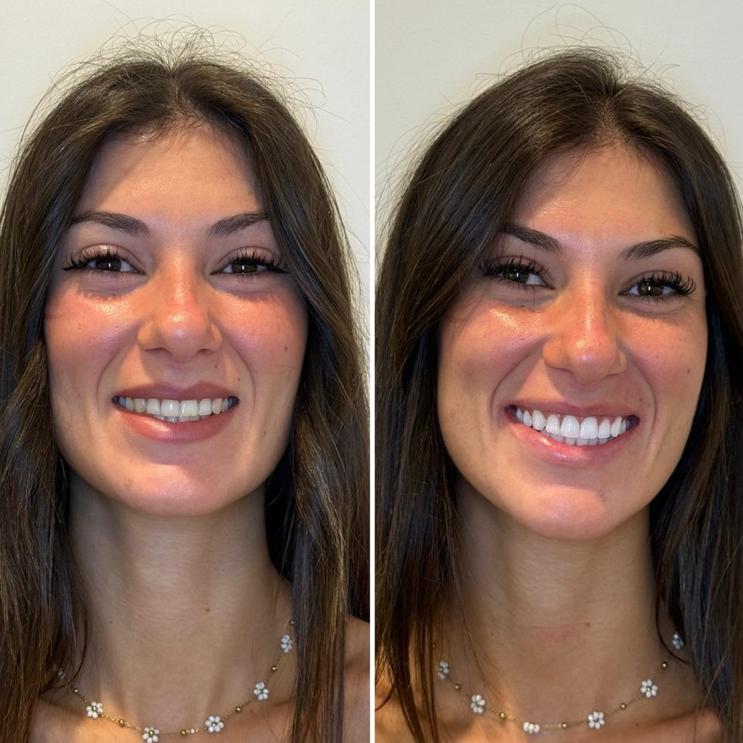 KIPA SMILE PRIMA E DOPO (30)