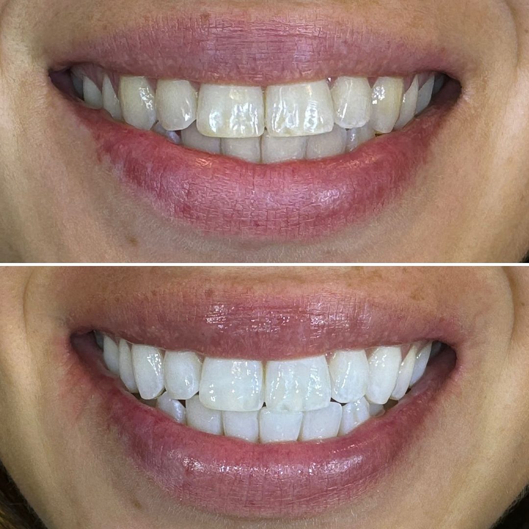 KIPA SMILE PRIMA E DOPO (31)