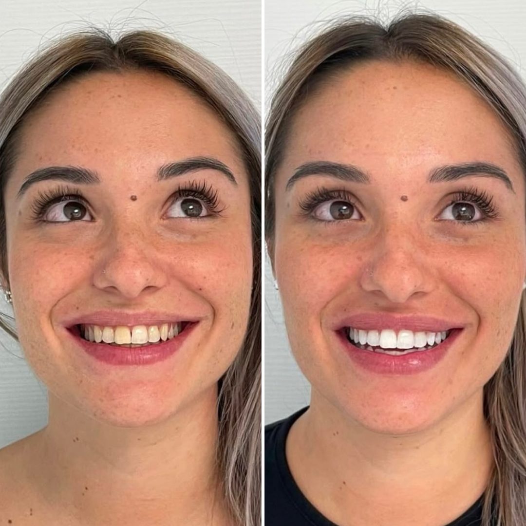 KIPA SMILE PRIMA E DOPO (33)