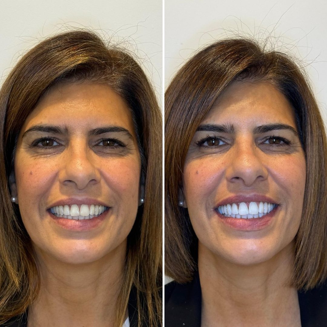 KIPA SMILE PRIMA E DOPO (34)