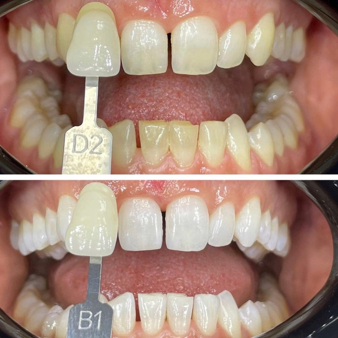 KIPA SMILE PRIMA E DOPO (35)