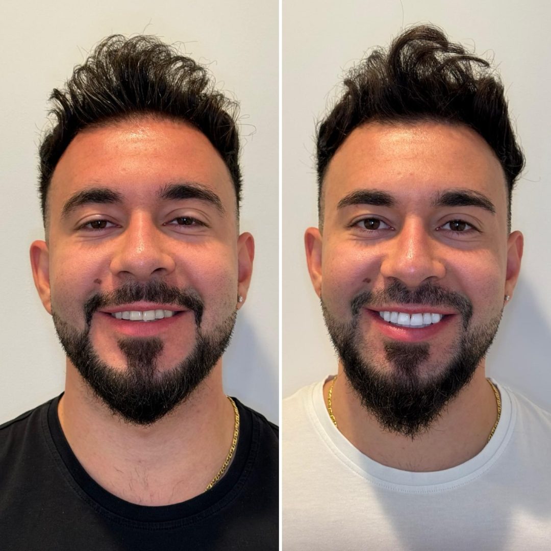 KIPA SMILE PRIMA E DOPO (4)