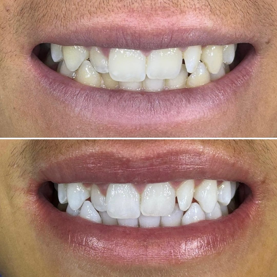 KIPA SMILE PRIMA E DOPO (5)