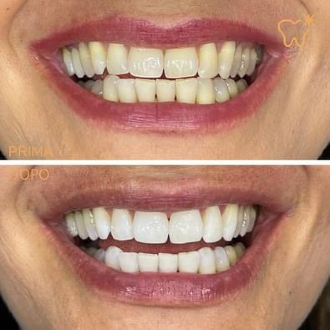 KIPA SMILE PRIMA E DOPO (6)