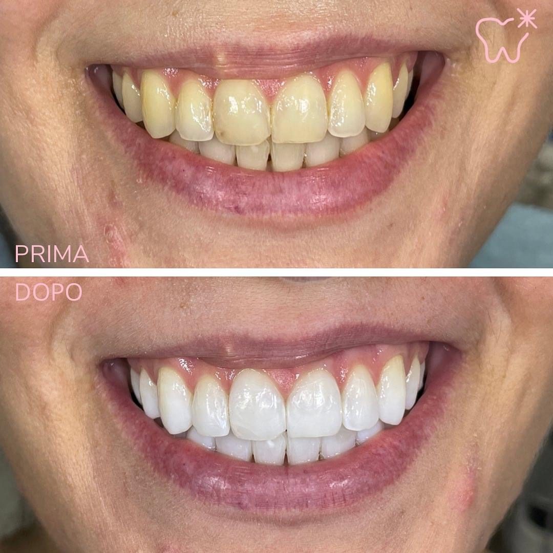 KIPA SMILE PRIMA E DOPO (7)