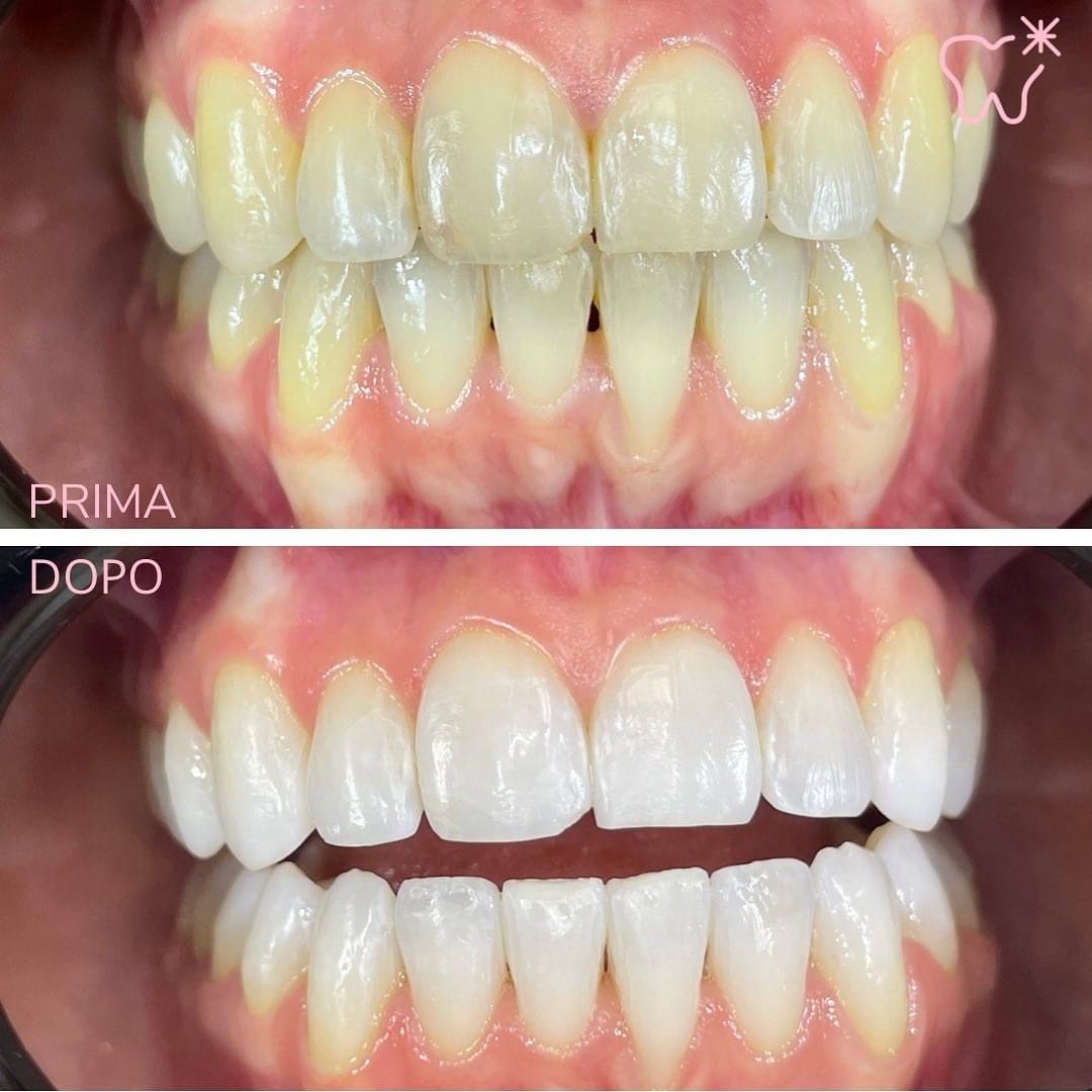 KIPA SMILE PRIMA E DOPO (8)