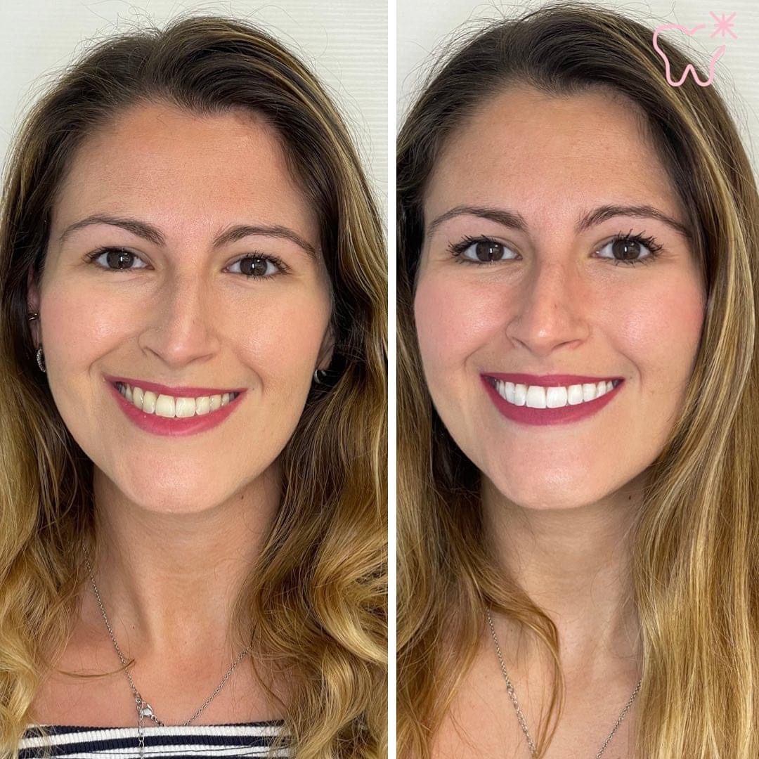 KIPA SMILE PRIMA E DOPO (9)