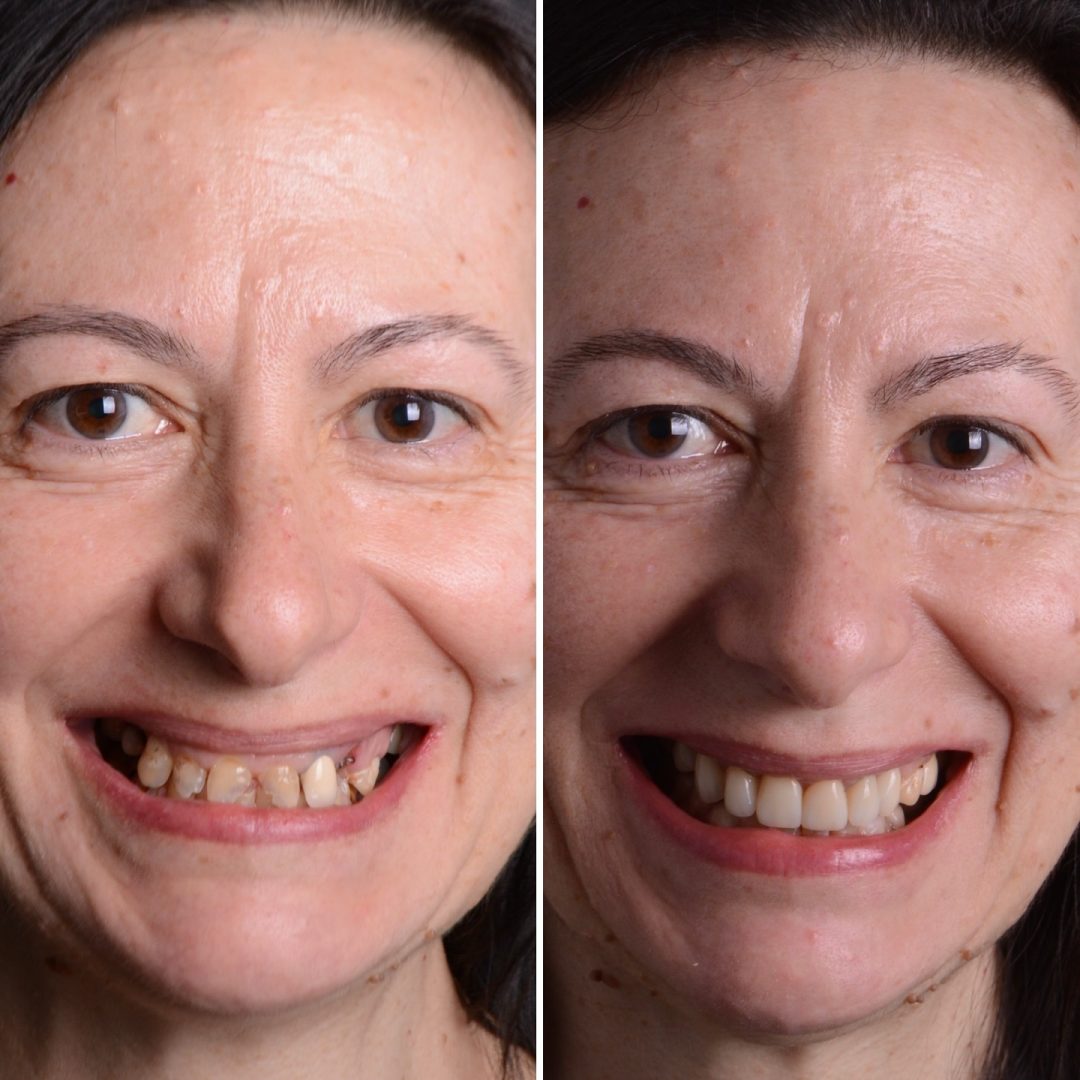 Metodo Aura prima e dopo (11)