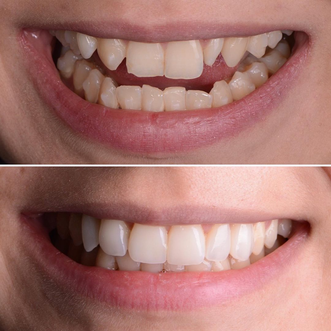 Metodo Aura prima e dopo (2)