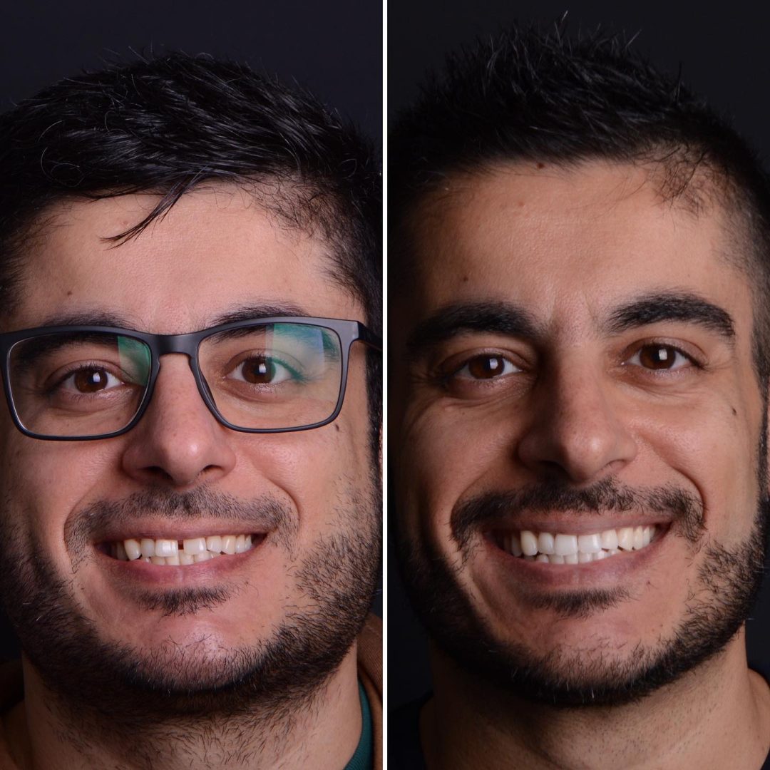 Metodo Aura prima e dopo (3)