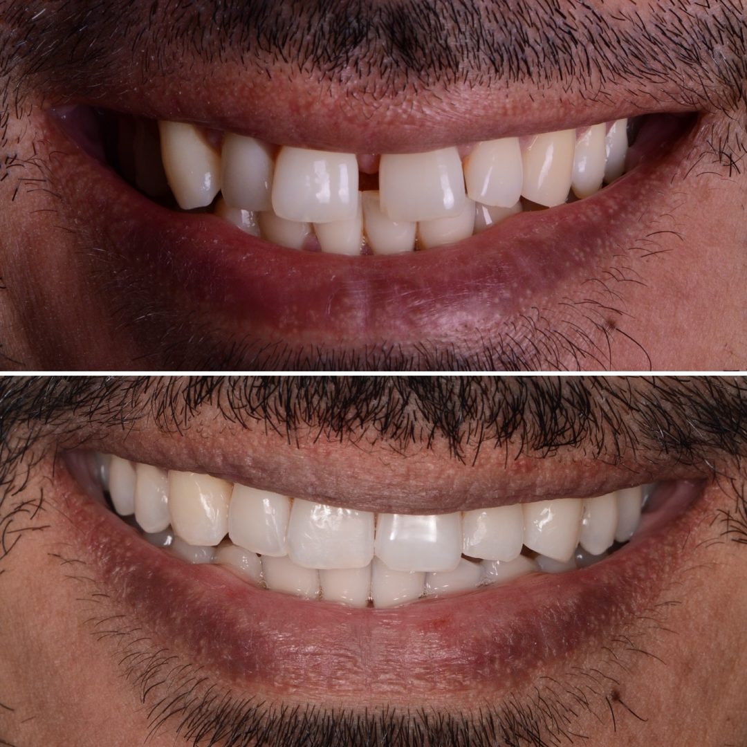 Metodo Aura prima e dopo (5)