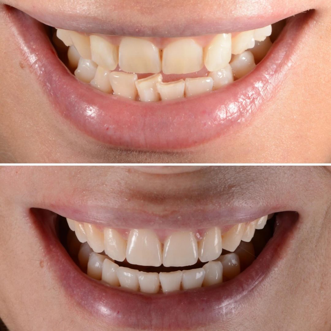 Metodo Aura prima e dopo (6)